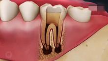 根管治疗让牙齿重获新生