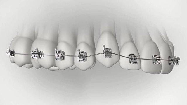 漳州牙齿矫正，牙齿矫正是否会疼痛呢？