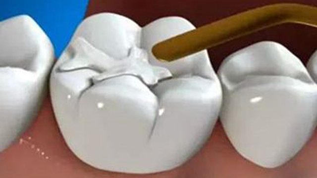 漳州补牙多少钱，树脂补牙是怎么样修复蛀牙的