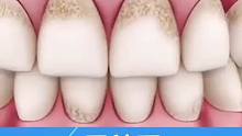 为什么要定期洗牙，洗牙可以有效预防牙齿出现问题！漳州洗牙价格