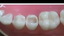 树脂补牙的过程是怎么样的?漳州补牙